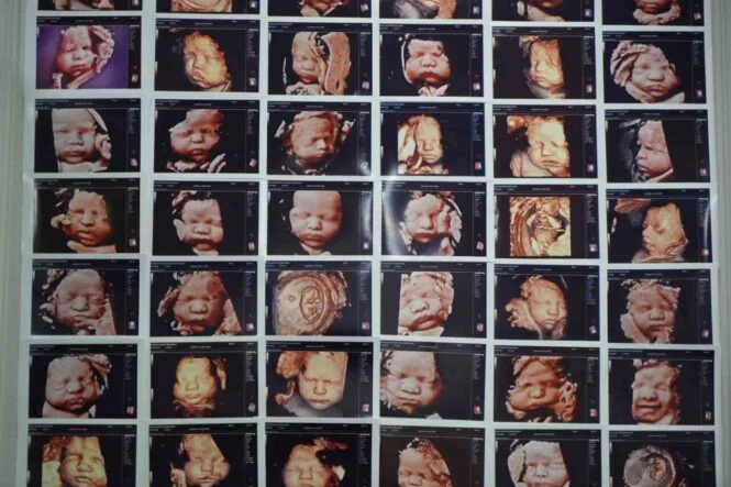 7 yıllık bebek hasreti "kişiye özel" tedaviyle son buldu